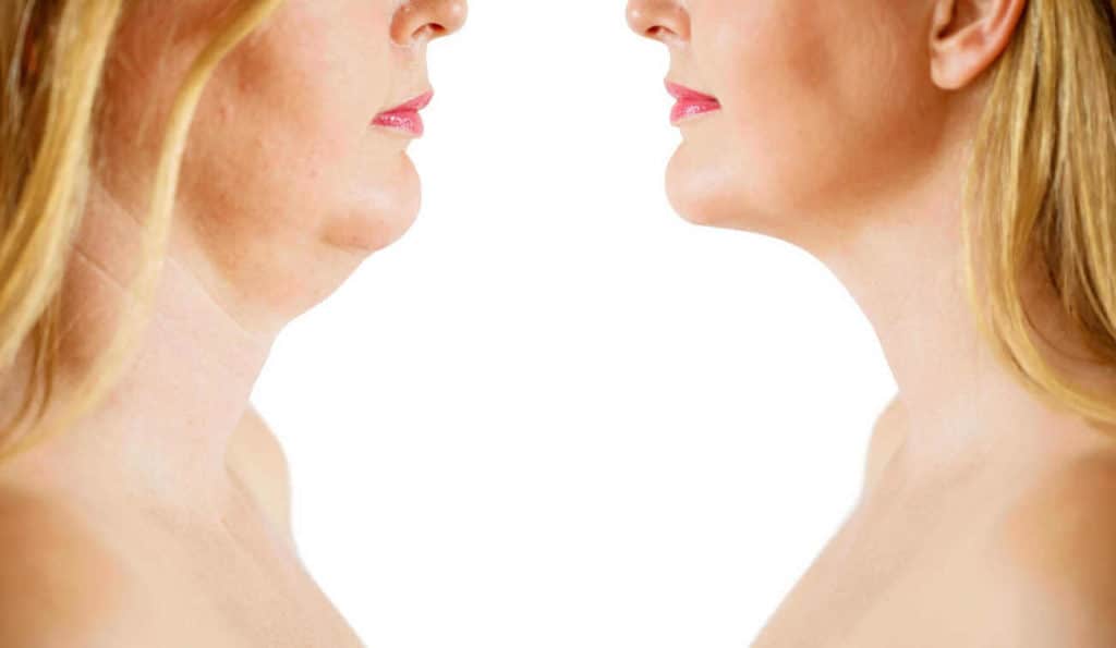 Double Chin treatment Bedfordshire before and after results