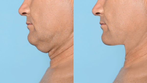 Which Non-Surgical Treatments Work Best for Jowls and Loose Skin Bedfordshire?