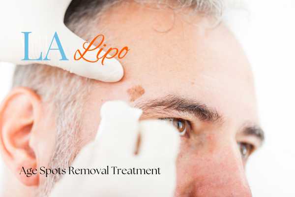 What Are the Most Effective Treatments for Age Spots Bedfordshire?