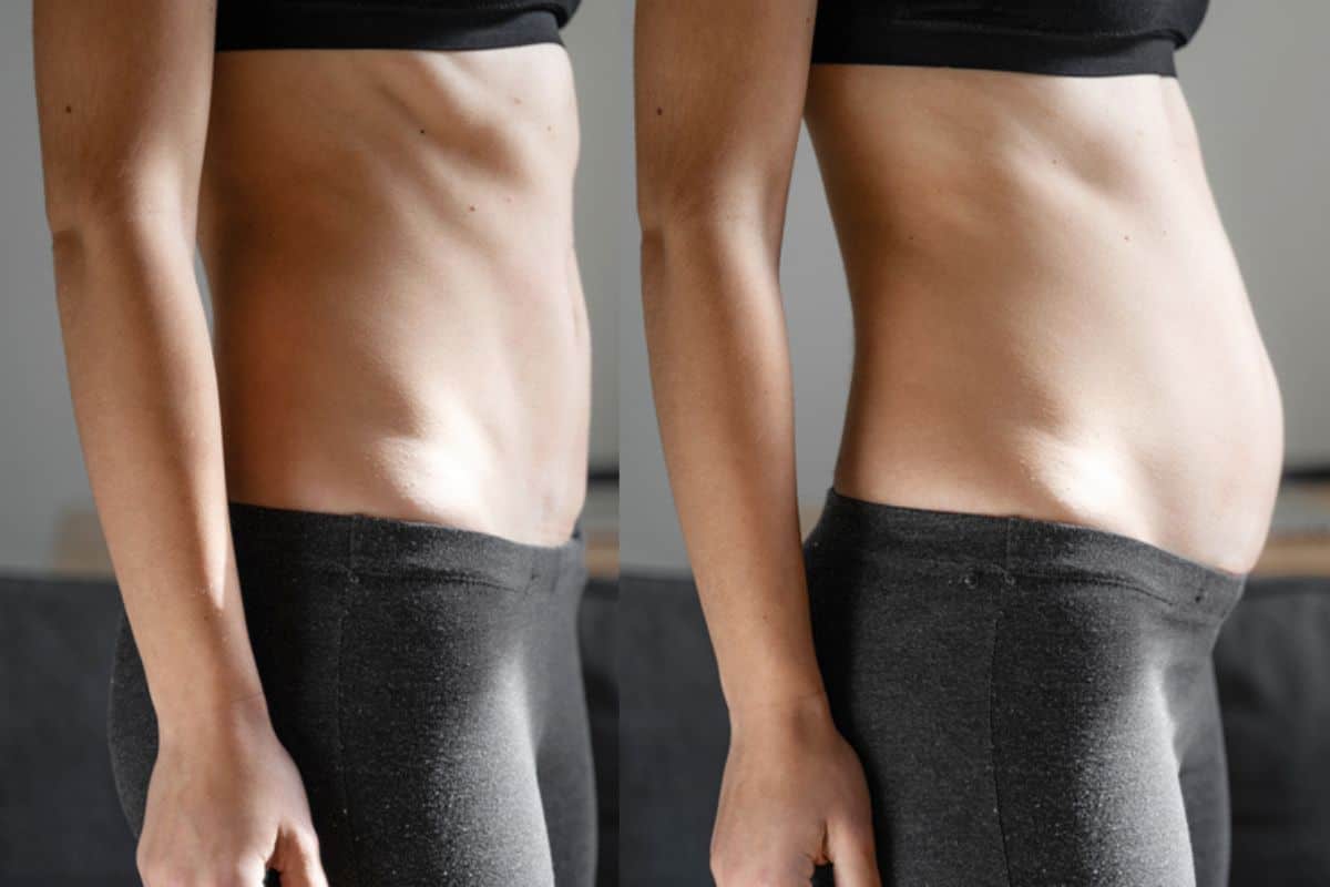 How long does diastasis recti take to improve Bedfordshire?