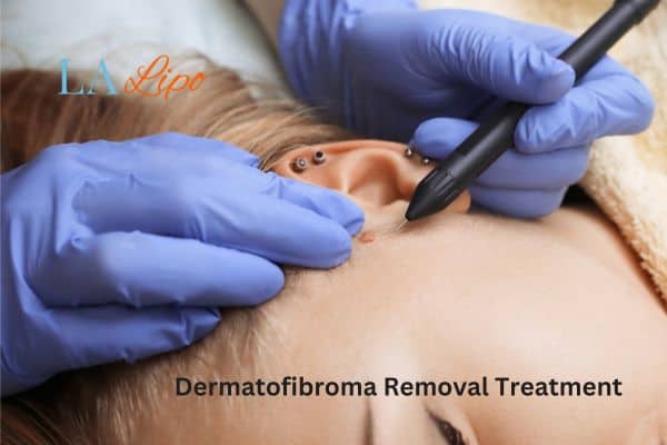 Dermatofibroma Removal Treatment Bedfordshire