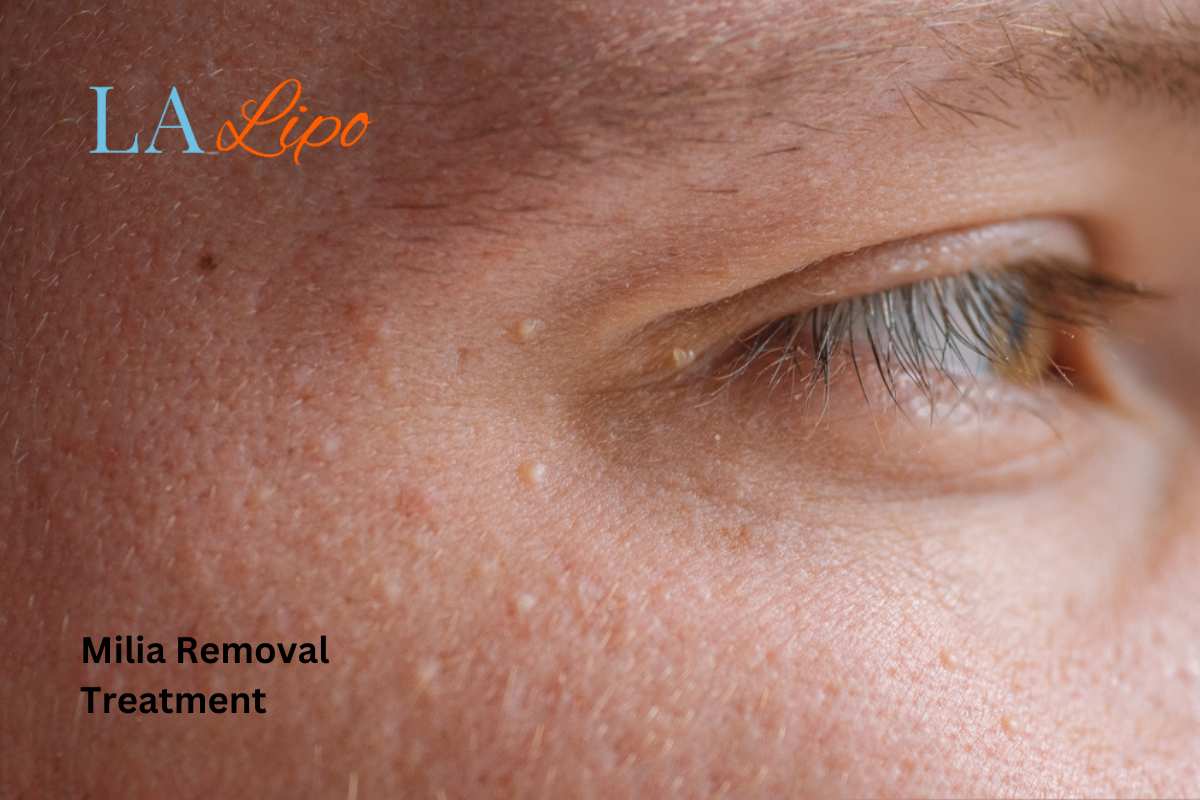 Cryopen Milia Removal: Is It the Easiest and Safest Option Bedfordshire?
