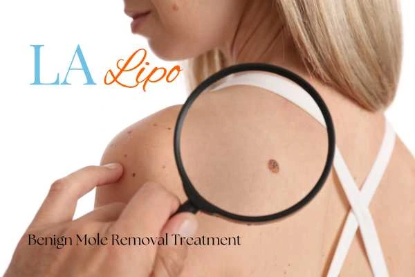 Woman having her inspection of blemish before mole removal Bedfordshire