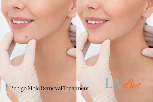 Before and after mole removal Bedfordshire treatment