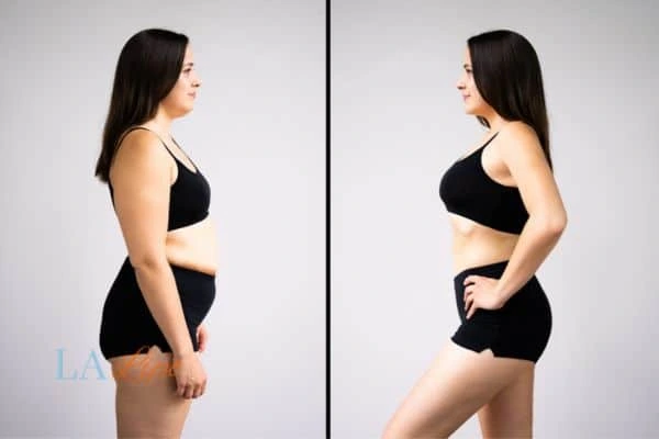 image of woman before and after results of LA-EMS Body Sculpting Bedfordshire to help treat Diastasis recti