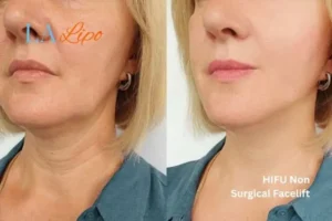 hi-fu for wrinkles Bedfordshire before and after results