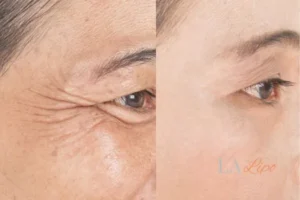 Before and after results of woman - HI-fu wrinkles reduction treatment Bedfordshire