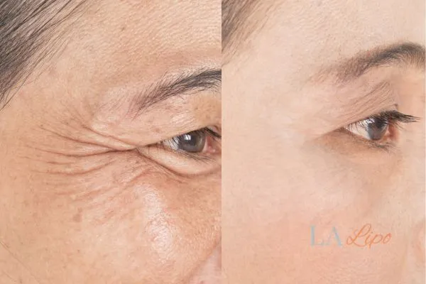 Before and after results of woman - HI-fu wrinkles reduction treatment Bedfordshire