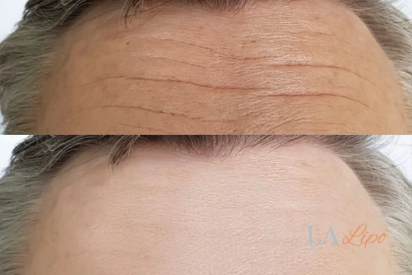 results of HIFU Bedfordshire on mans forehead to help reduce lines and wrinkles