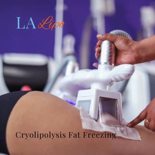 fat freezing - Cryolipolysis Bedfordshire