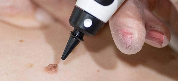 skin tag removal using cryopen Bedfordshire