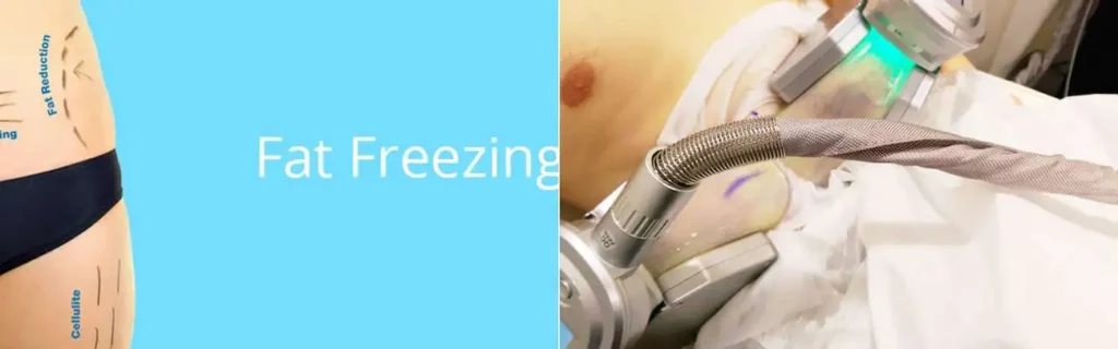Fat freezing Bedfordshire on multiple areas of the body