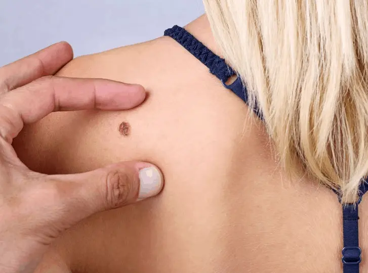 woman having mole removal Bedfordshire consultation before treatment.