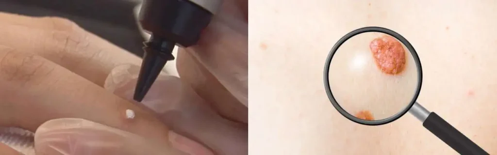 Cryopen for mole removal Bedfordshire - speak to our team today!