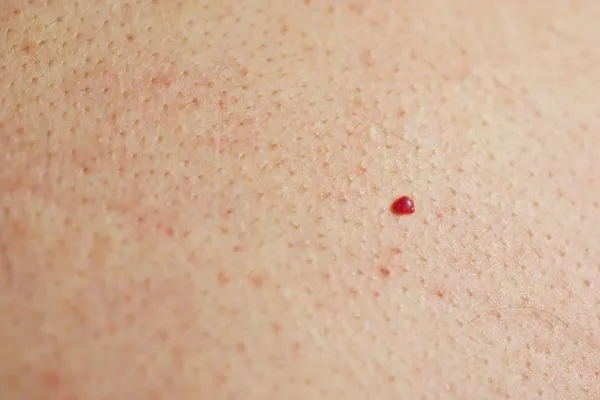 close up of a cherry angioma Bedfordshire