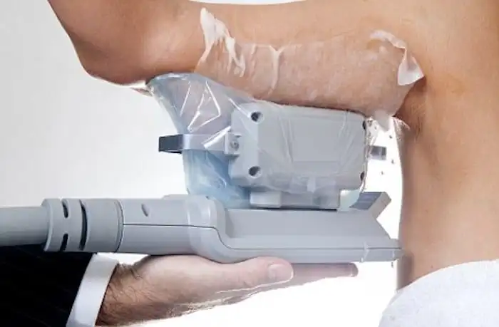 Picture of fat freezing Bedfordshire on the upper arms.