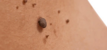 image of a skin tag Bedfordshire