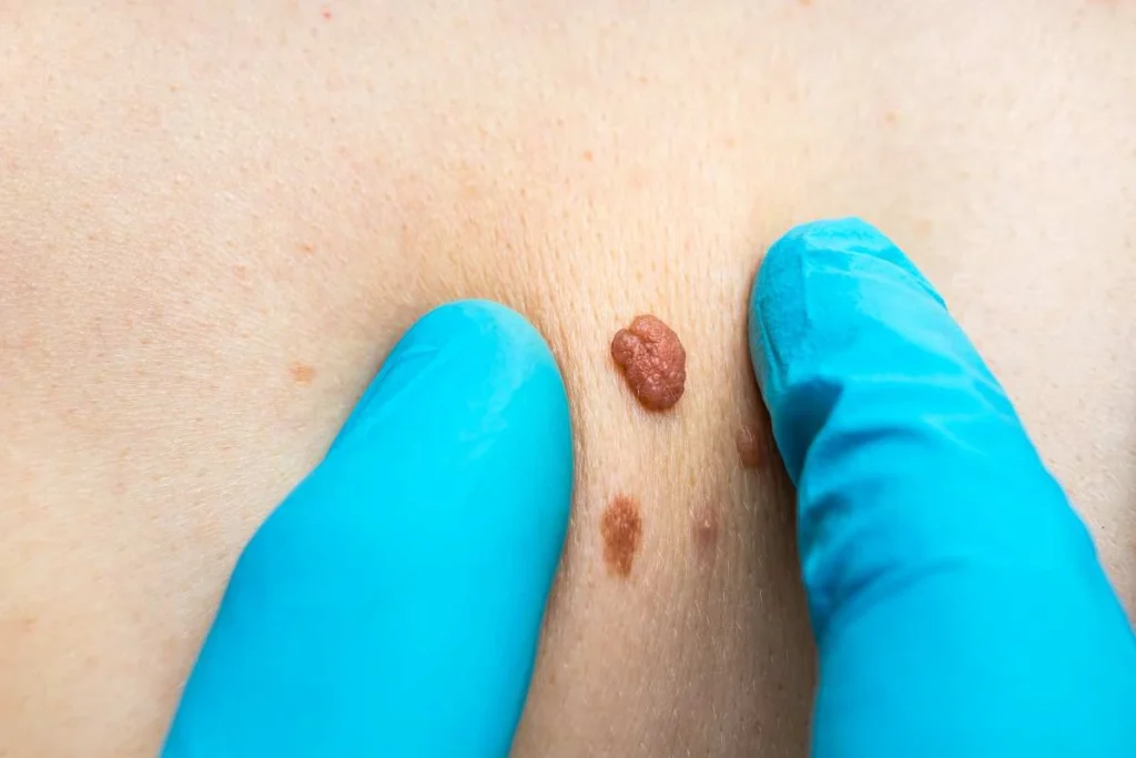 Consultant examining a skin tag Bedfordshire