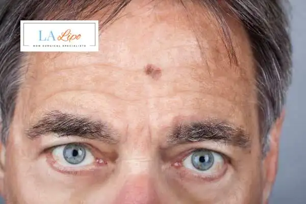 Solar Lentigo Removal Bedfordshire image of man with mark on his forehead