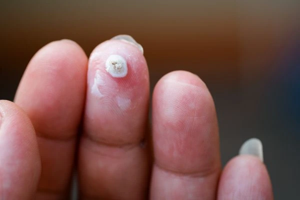 wart on person finger - cryotherapy to treat from LA LIPO Bedfordshire