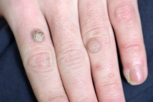photo of warts on person hand - see wart removal Bedfordshire from LA LIPO