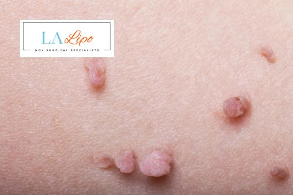 Does cryopen skin tag removal Bedfordshire hurt? Find out now call our team today!