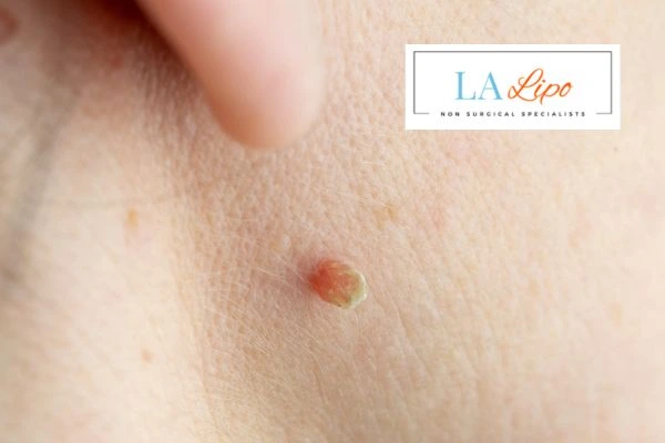 Book skin tag removal Bedfordshire today speak to our team now!