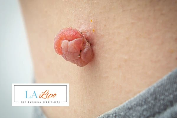 Interested in skin tag removal Bedfordshire? Concerned about the pain? Find out more today!