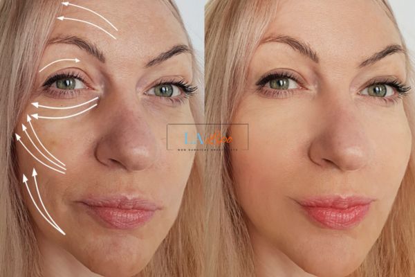 Morpheus 8 results Bedfordshire face lift.