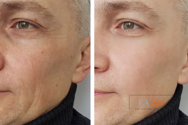 See the amazing results of Morpheus8 Treatment Bedfordshire!