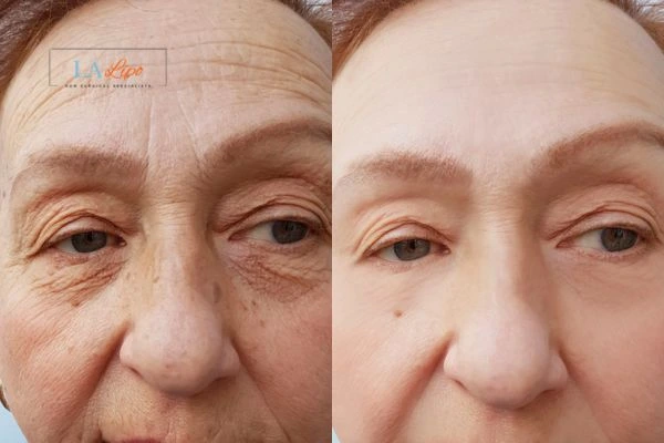 The powerful benefits of Morpheus8 Treatment Bedfordshire - Call Our team today!