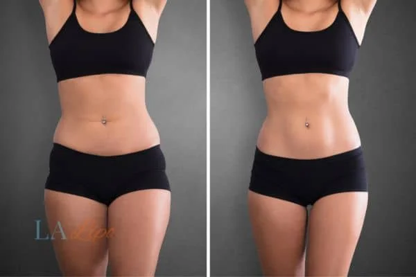 before and after results of non-surgical treatment to help a woman's body image and mental health Bedfordshire