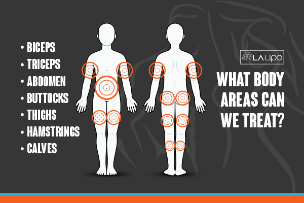 Diagram to show areas you can have LA-EMS Body Sculpting Treatment Bedfordshire