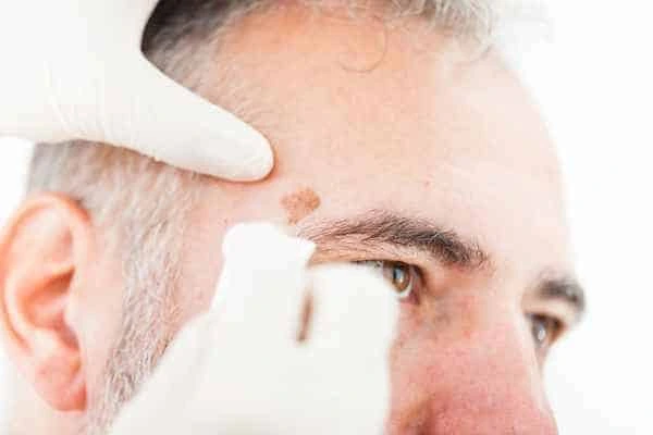 Age spots and elderly people Bedfordshire what is the link?