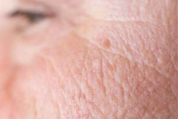 close up picture of a woman's face showing an age spot Bedfordshire