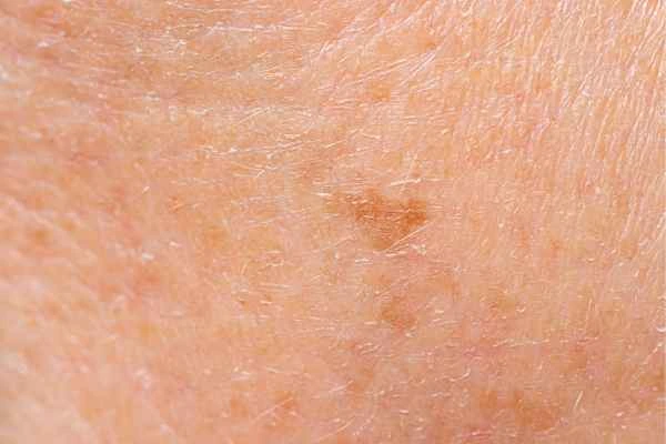 close up picture of age spots Bedfordshire
