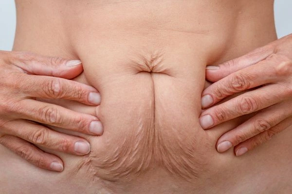 Image of a woman's stomach with loose skin - example of skin tightening Bedfordshire options
