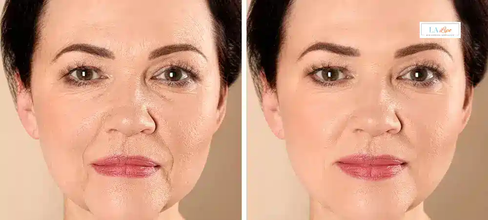 How Long Does It Take to See Results and How Long Do They Last Bedfordshire?