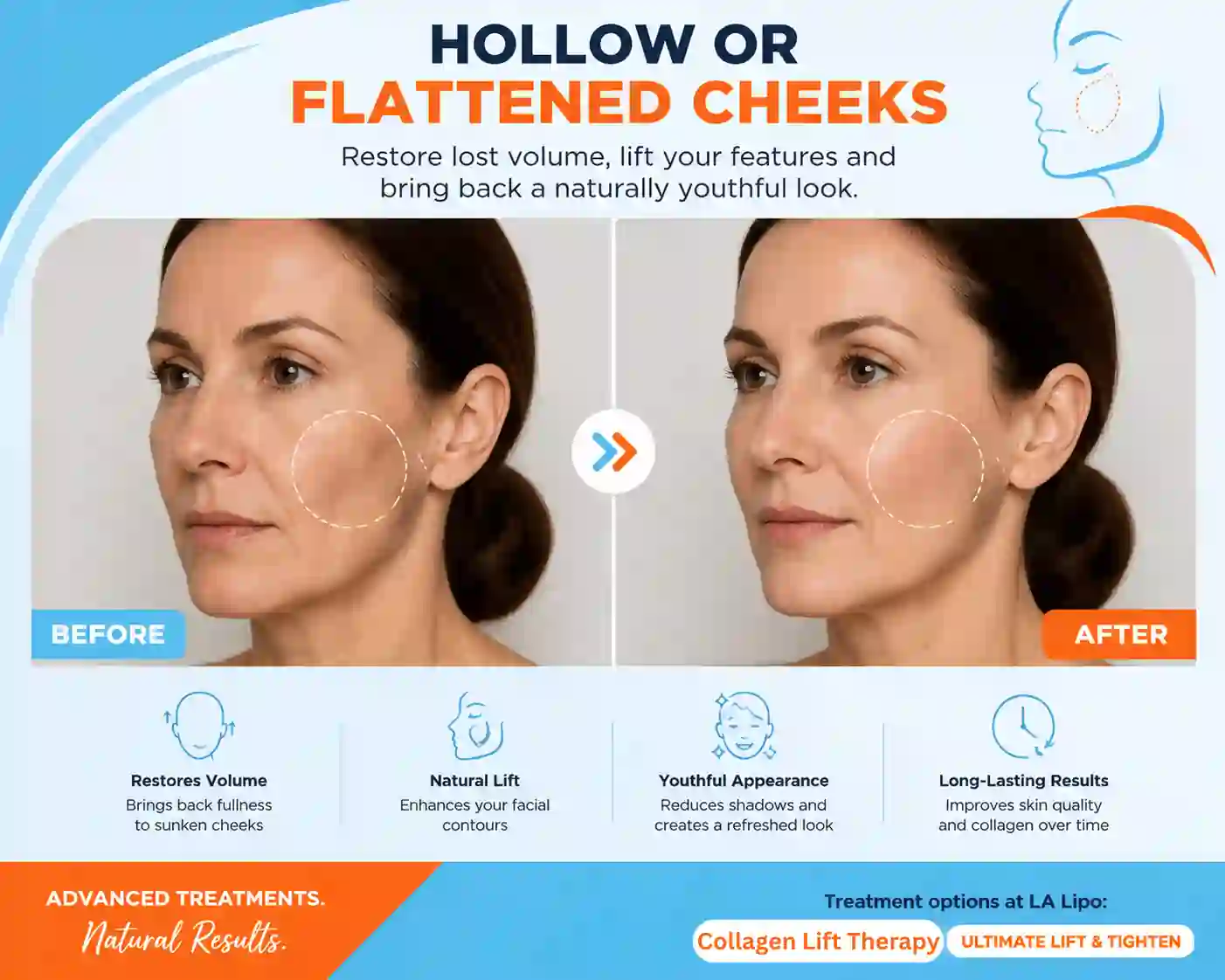 Sign #4: Hollow or Flattened Cheeks Bedfordshire