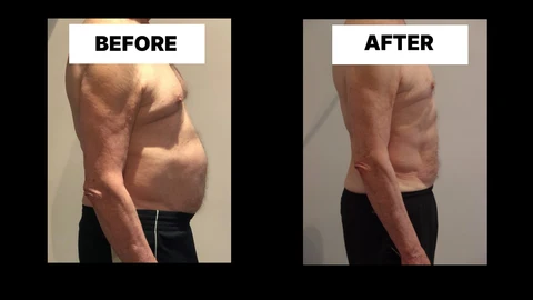 What Symptoms Can Diastasis Recti Cause in Men? Weak Core, Back Pain and Poor Posture Bedfordshire